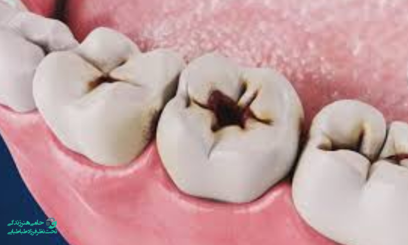 تاثیر مصرف ماده مخدر شیشه بر سلامت دندان ها